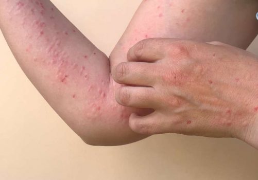 Monkey,Pox,Virus,,A,New,World,Problem,Of,Modern,Humanity.